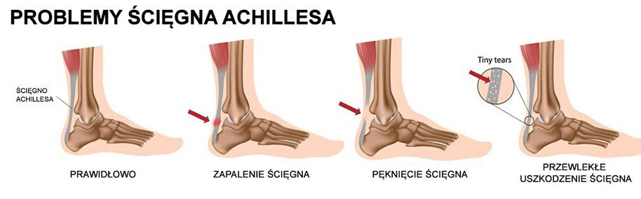 achilles1