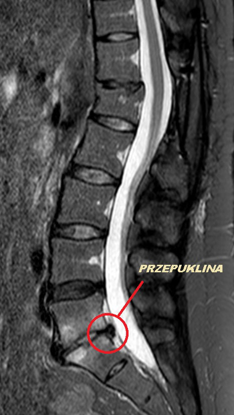 przepuklina